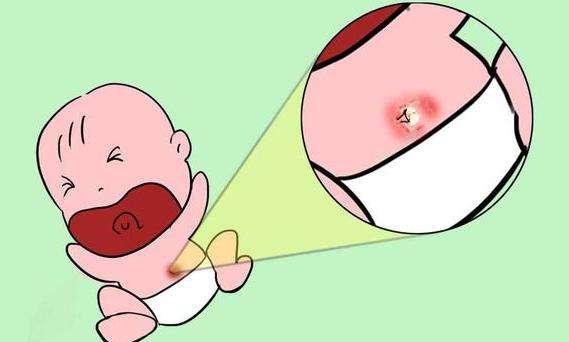  宝宝的脐带护理你懂多少